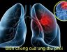 Những biến chứng của bệnh ung thư phổi gây nguy hiểm như thế nào?