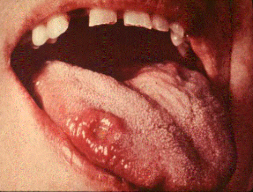 Những hình ảnh của ung thư lưỡi bị vết thương loang lổ