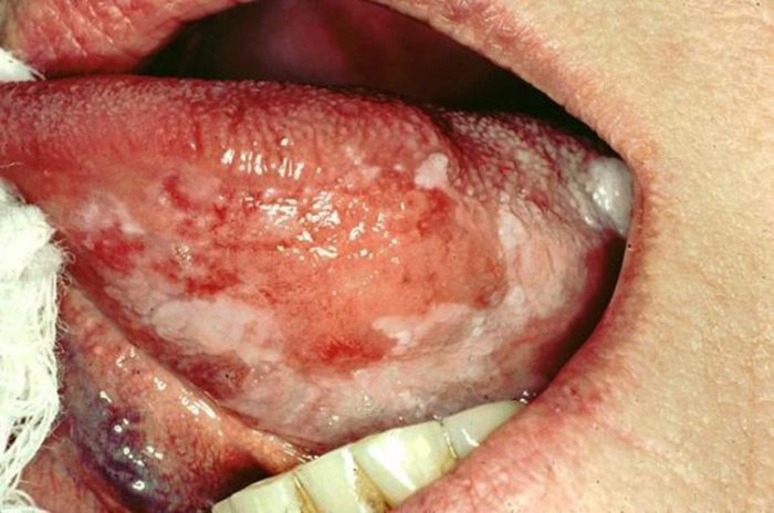 Chảy máu ở lưỡi là biểu hiện của ung thư lưỡi