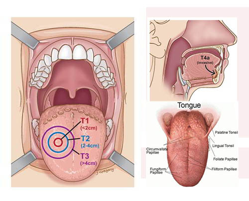 Phẫu thuật ung thư lưỡi sẽ giúp loại bỏ triệt để tế bào ung thư