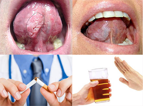 Bạn có thể phòng tránh ung thư lưỡi bằng cách ngưng hút thuốc lá, uống rượu bia