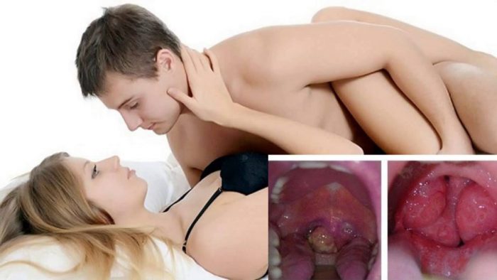 Tình dục bằng miệng là nguyên nhân gây nên ung thư vòm họng