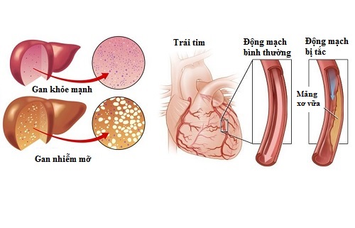 Mỡ máu cao khiến gan nhiễm mỡ và gây bệnh tim mạch