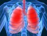Thuốc trị ung thư phổi giai đoạn cuối có thể kéo dài bao lâu?