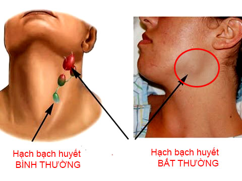 Xuất hiện các hạch bất thường xung quanh vùng cổ có thể là biểu hiện của ung thư vòm họng