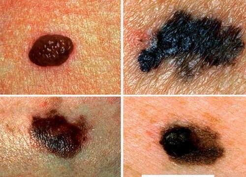 Triệu chứng của bệnh ung thư da là gì?