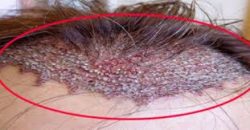 Triệu chứng của ung thư da đầu