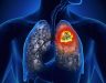 Triệu chứng ung thư phổi giai đoạn đầu tuyệt đối không nên bỏ qua