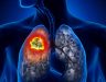 Ung thư phổi di căn hạch trung thất chữa thế nào, sống được bao lâu?