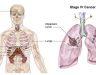 Ung thư buồng trứng di căn phổi: Dấu hiệu và cách điều trị
