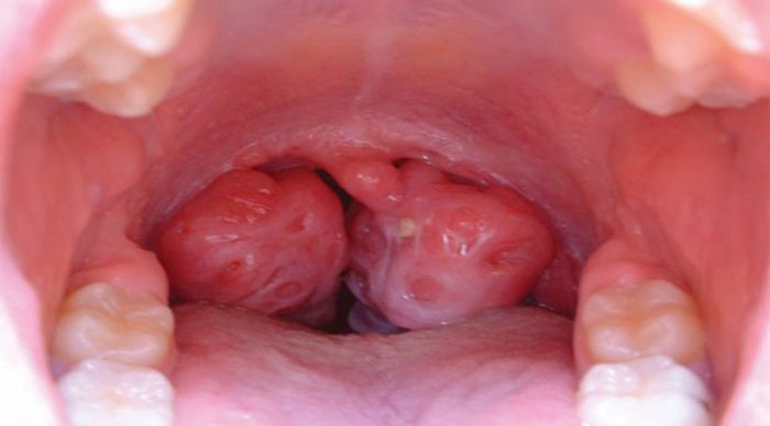 Ung thư cổ họng có chữa được không ?