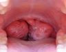 Ung thư cổ họng có chữa được không? Cách điều trị như thế nào?