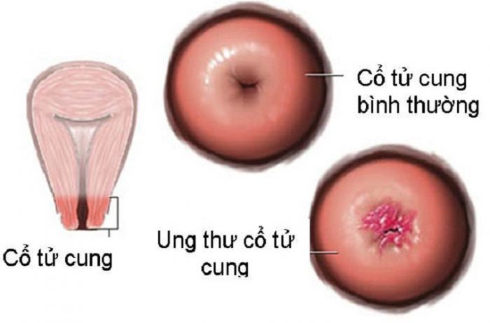 Hình ảnh ung thư cổ tử cung, sự phát triển bất thường của các tế bào cổ tử cung