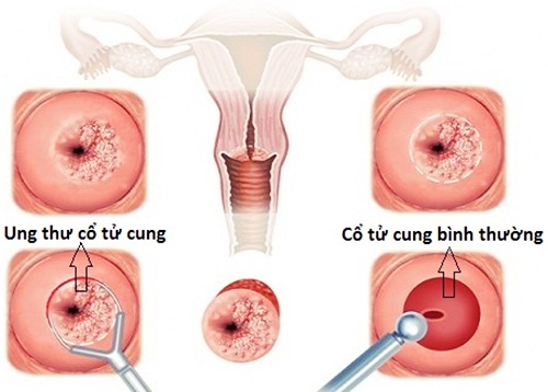 Hình ảnh ung thư cổ tử cung.