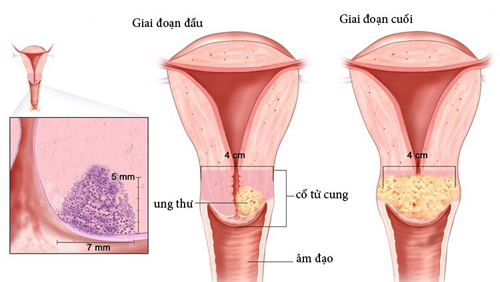 Khám gì để biết ung thư cổ tử cung?