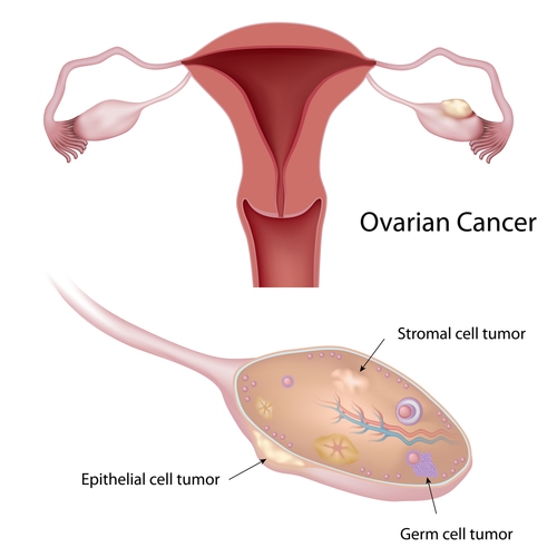 Ung thư cổ tử cung giai đoạn 3.