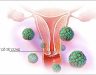 Ung thư cổ tử cung: Triệu chứng, nguyên nhân, chữa Ung thư tử cung
