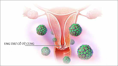 Ung thư cổ tử cung là gì? Bệnh có nguy hiểm không?