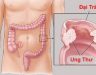 Ung thư đại tràng di căn hạch ổ bụng và các biến chứng thường gặp