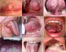 Ung thư lưỡi: Triệu chứng, nguyên nhân và điều trị bệnh ung thư lưỡi