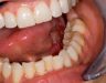 Ung thư lưỡi có biểu hiện như thế nào khi bệnh ở giai đoạn đầu?