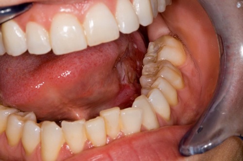 Ung thư lưỡi có biểu hiện như thế nào?
