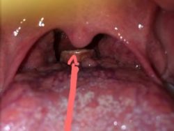 Ung thư lưỡi biến chứng sang viêm amidan.