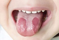 Những đốm loét xuất hiện trên lưỡi gây ung thư lưỡi