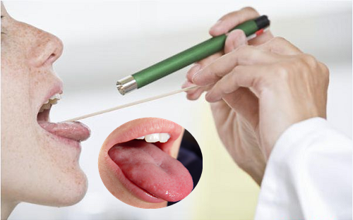 Ung thư lưỡi sống được mấy năm phụ thuộc nhiều vào thời gian phát hiện bệnh