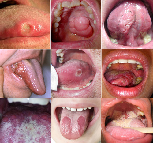 Ung thư lưỡi - Một trong những căn bệnh nguy hiểm dễ bị nhầm lẫn với bệnh nhiệt miệng