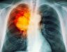 Ung thư màng phổi sống được bao lâu? Phương pháp điều trị bệnh