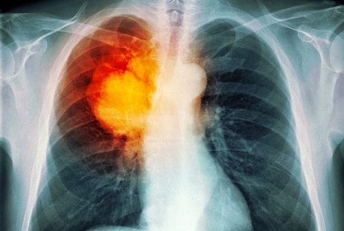 Ung thư màng phổi sống được bao lâu