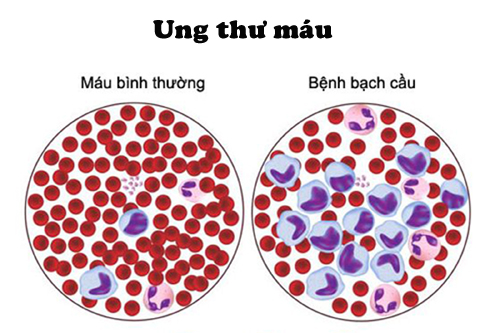 Tế bào máu khi bị ung thư