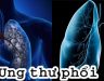Ung thư phổi: Triệu chứng, nguyên nhân và điều trị bệnh ung thư phổi