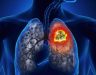 Bệnh ung thư phổi giai đoạn 3: Triệu chứng và cách điều trị bệnh