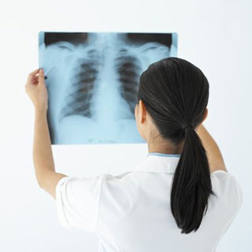 Bệnh ung thư phổi có thể di truyền.