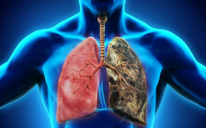 Ung thư phổi có di truyền hay không là hoàn toàn không thể