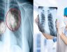 Ung thư phổi có điều trị được không? Cách điều trị ung thư phổi