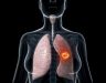 Ung thư phổi có lây không? Mức độ nguy hiểm của bệnh ung thư phổi