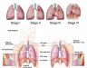 Ung thư phổi có mấy giai đoạn? Ung thư phổi có chữa được không?