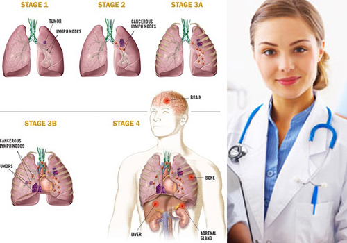 Ung thư phổi có mấy giai đoạn? Bệnh có nguy hiểm không?