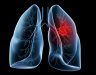 Ung thư phổi di căn có chữa được không? Cách điều trị như thế nào?