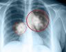 Ung thư phổi di căn xương có sống được không? Biến chứng bệnh