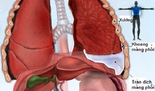 Ung thư phổi gây tràn dịch màng phổi và các biến chứng thường gặp