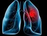 Ung thư phổi lây qua đường nào? Cách phòng bệnh ung thư phổi