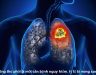 Ung thư phổi nên uống thuốc gì? Nấm lim xanh chữa ung thư phổi?