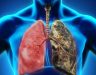 Bệnh ung thư phổi sống được bao lâu? Cách điều trị ung thư phổi