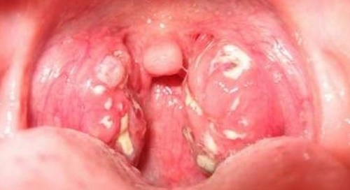 Bệnh nhân ung thư vòm họng cần tuân thủ chế độ ăn của bác sĩ