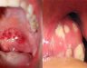 Ung thư vòm họng: Nguyên nhân, triệu chứng, chữa ung thư vòm họng