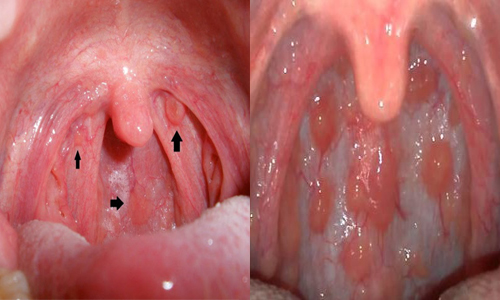 Biểu hiện của ung thư vòm họng giai đoạn 1 là tổn thương họng